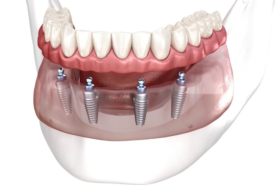 Implantologia Dentale All On Four