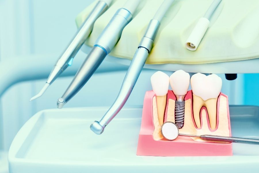 Implantologia Dentale a Sassari