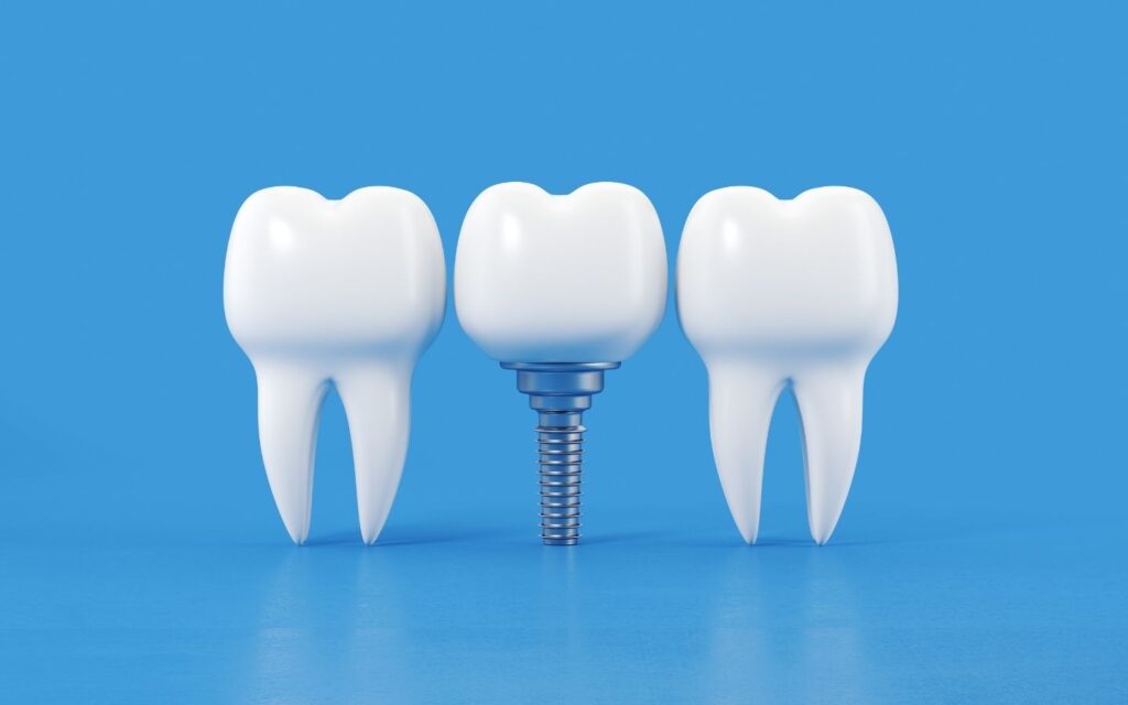 Implantologia Dentale a Sassari